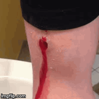 Image: Schusswunde am Arm mit pulsierender Blutung